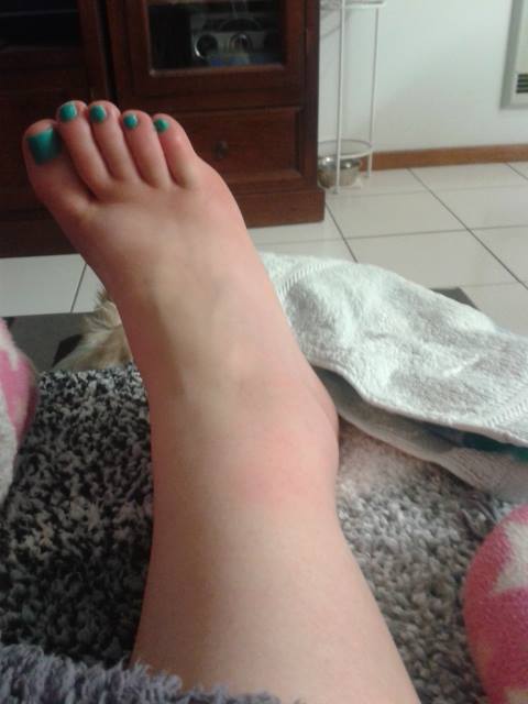 Climbing on slippery rock pools with no shoes = sprained ankle for two weeks :(